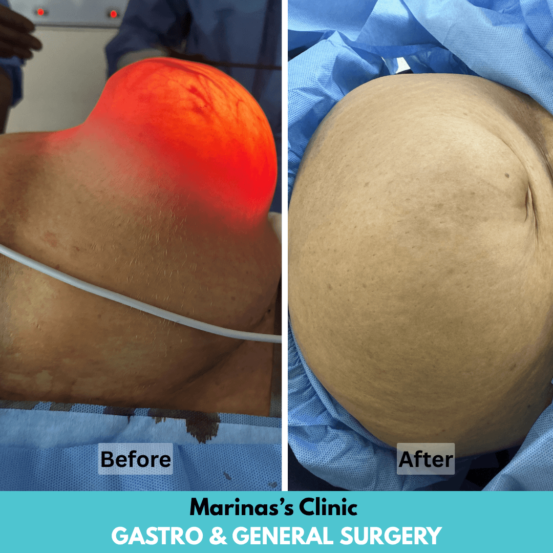 Hernia treatment reference image