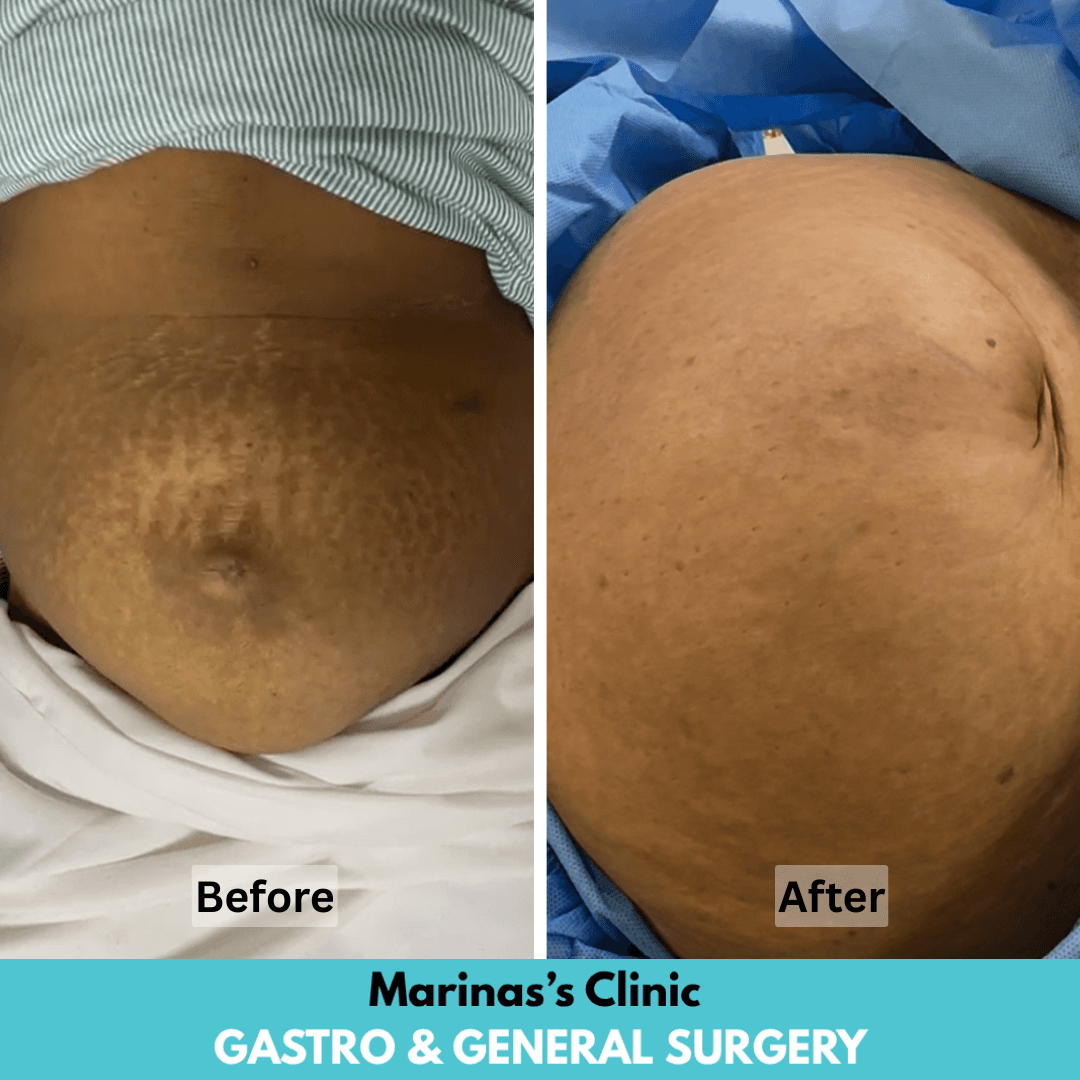 Modern hernia care reference image