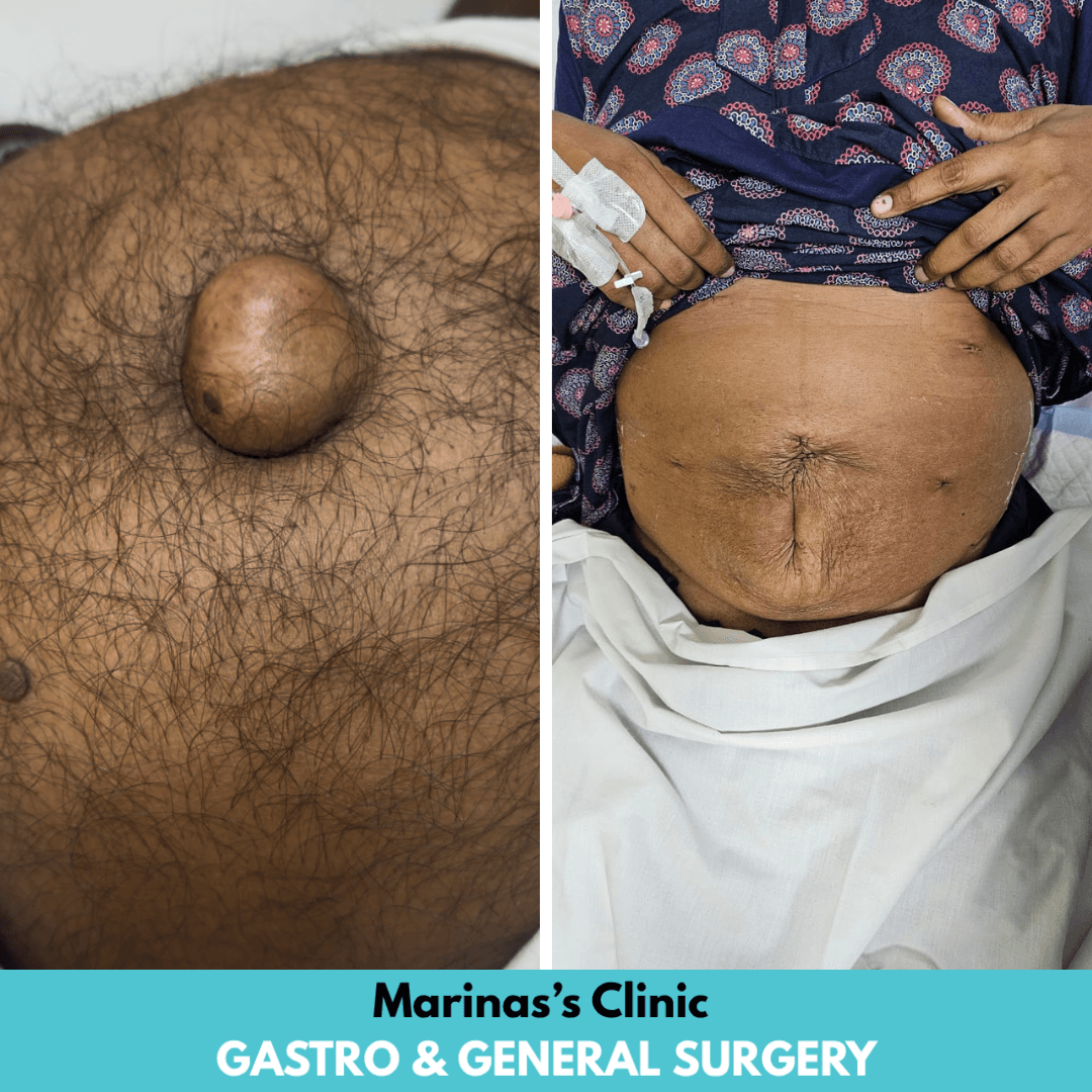 Hernia consultation reference image