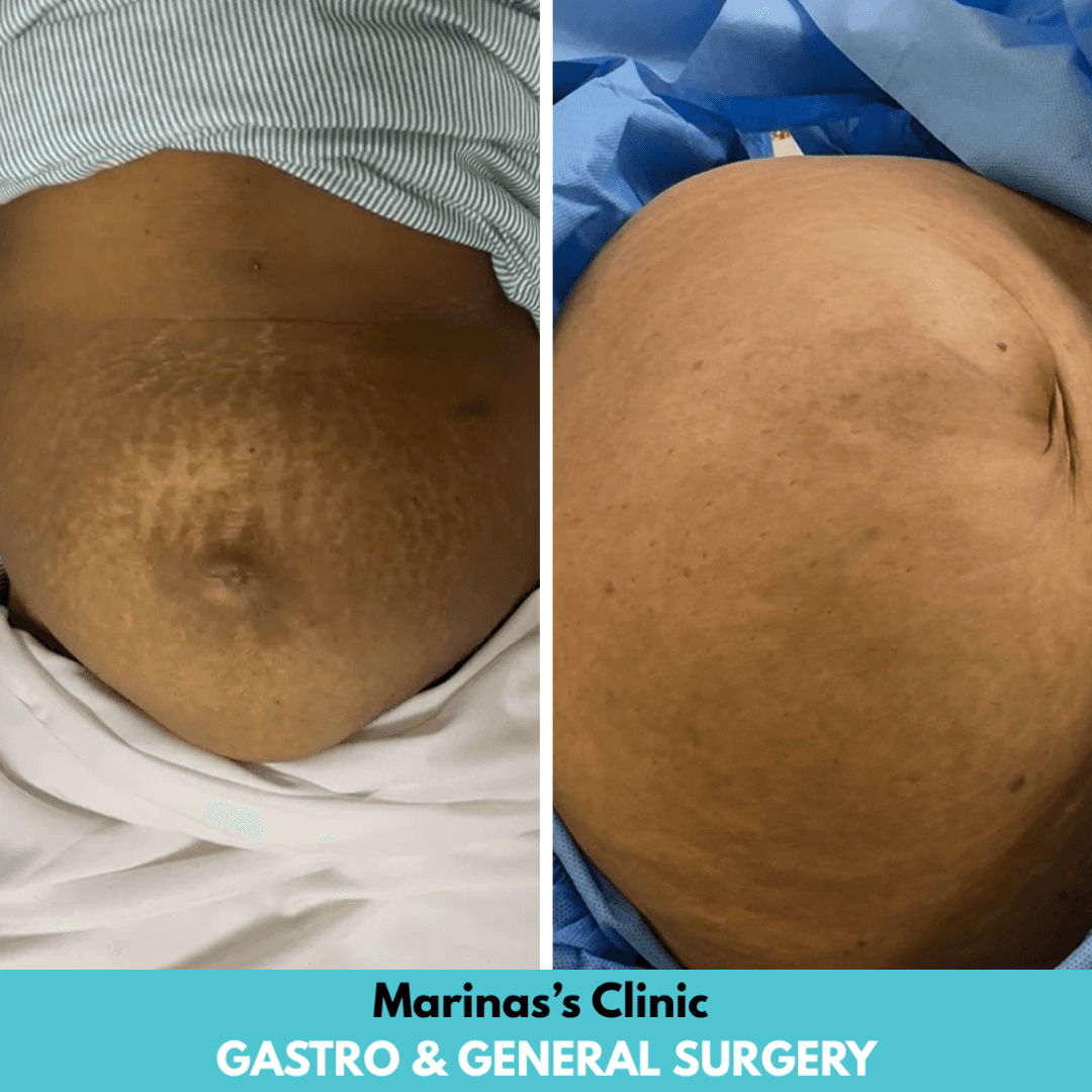 Modern hernia care reference image
