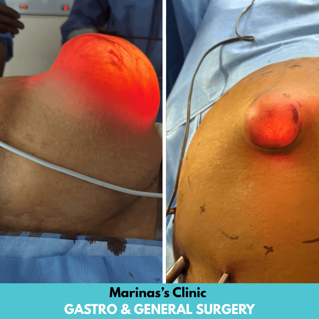 Hernia treatment reference image